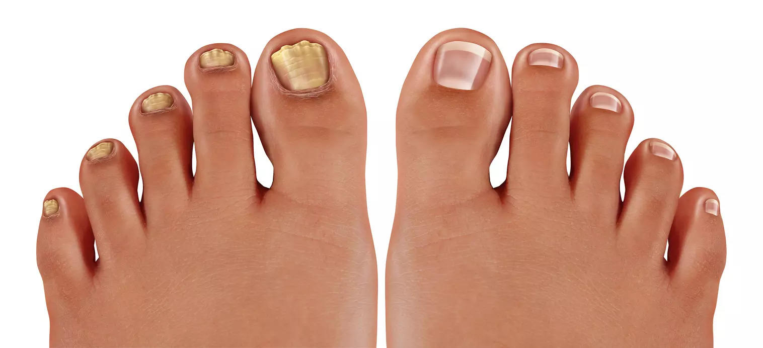 Heard of Onychomycosis? That's toenail fungal infection: 7 steps to prevent  fungus growth on the foot