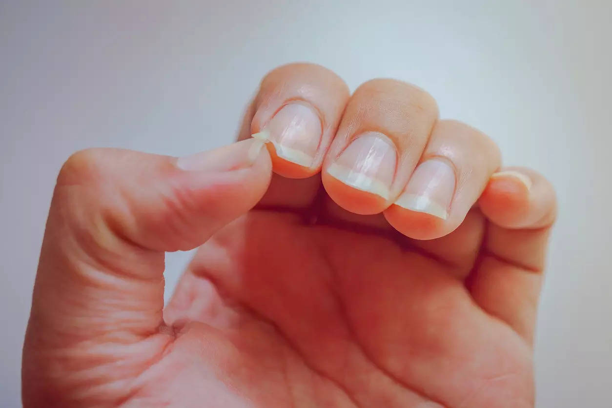 Do you bite your nails often? Here's why you shouldn't do it