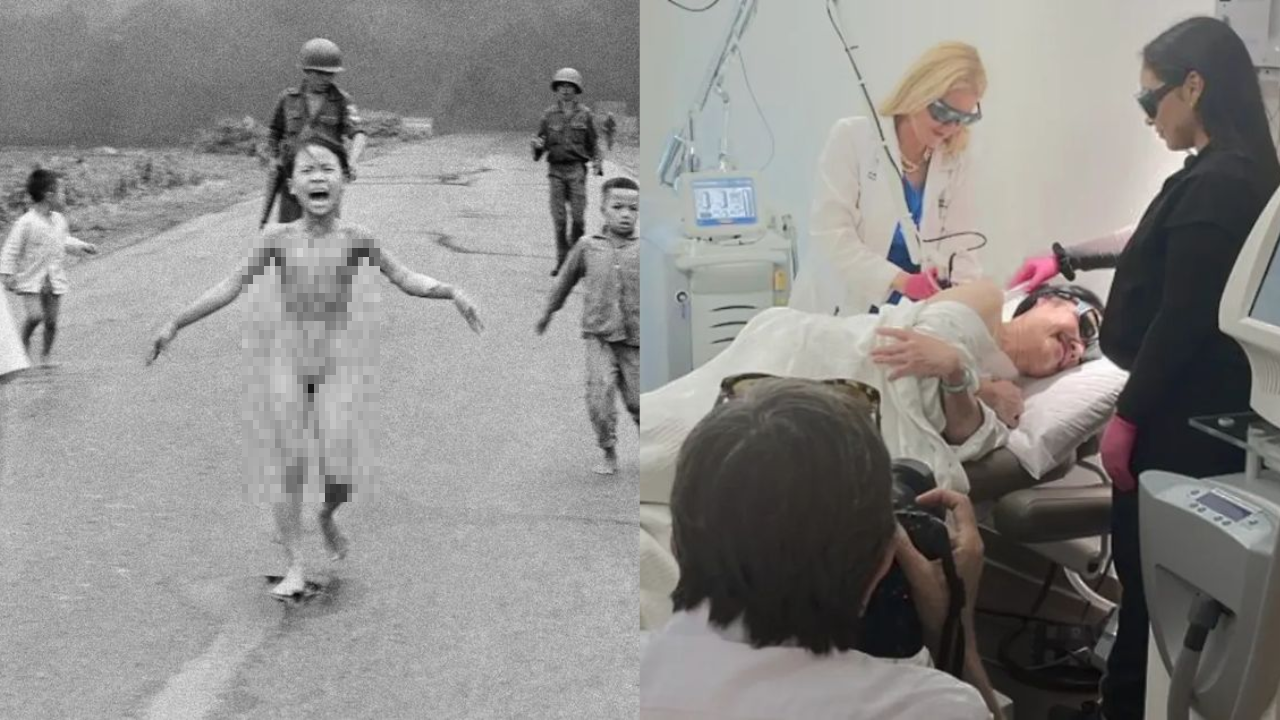 Dziewczyna z napalmem na zdjęciu z wojny w Wietnamie zostaje ostatecznie poddana leczeniu oparzenia 50 lat później