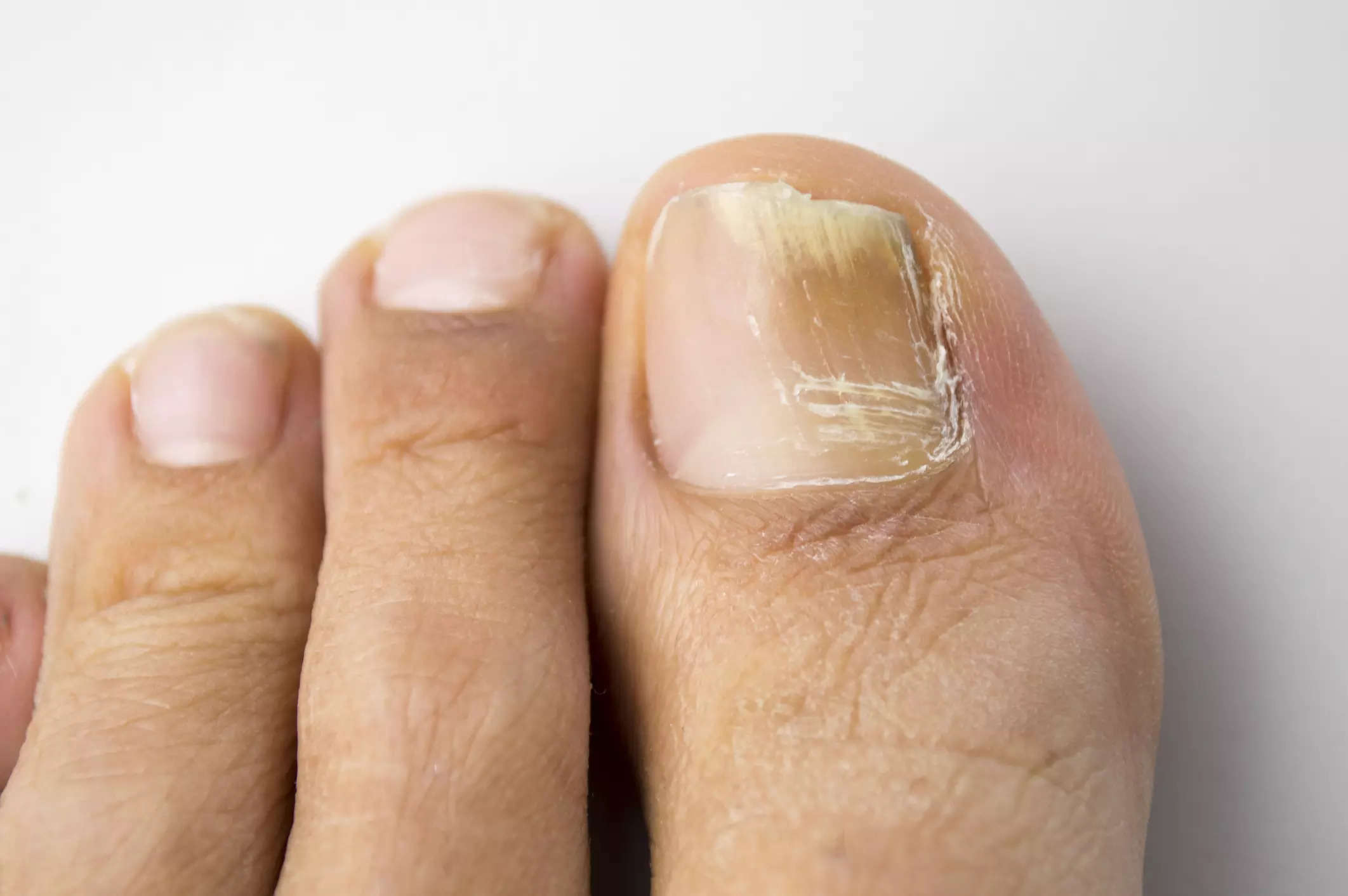 what-do-toenails-say-about-your-health