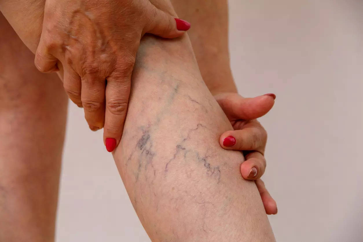 Red flag signs of varicose veins