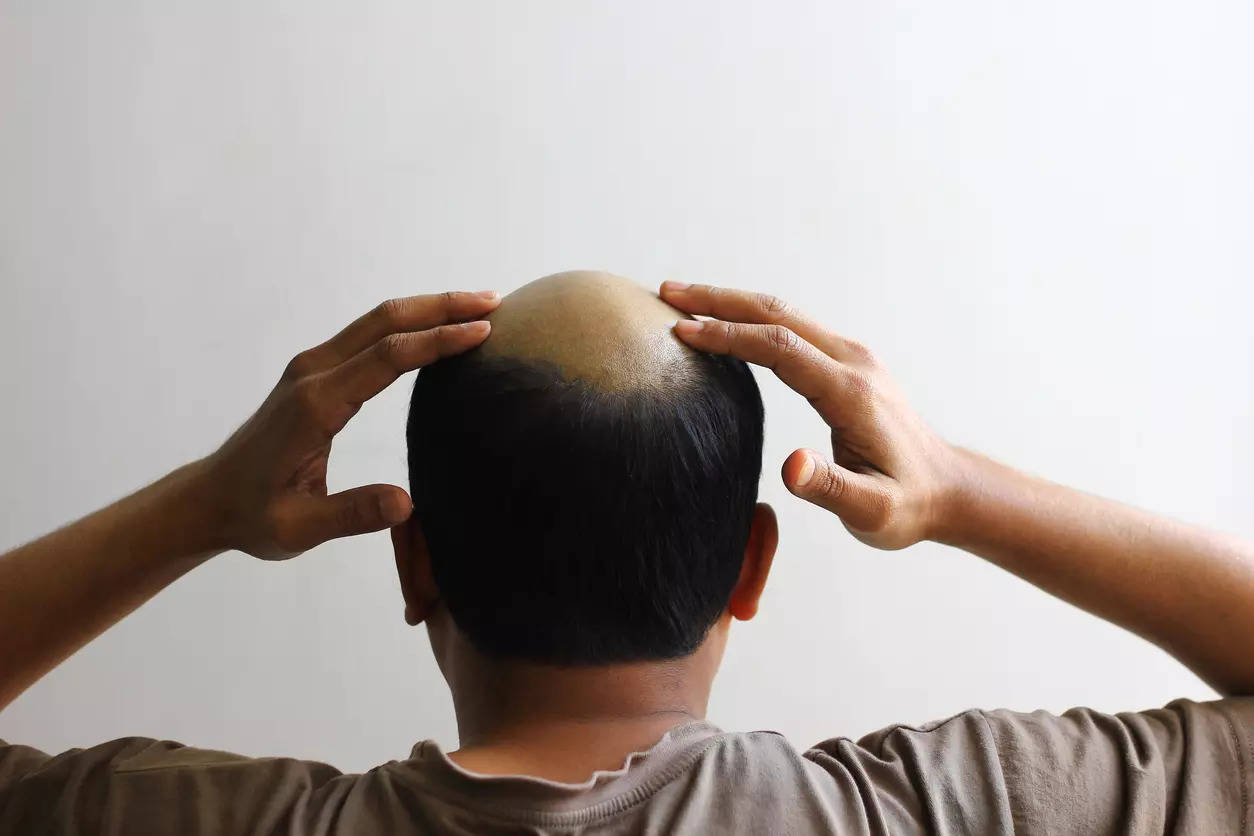 Researchers discover key chemicals in hair follicles that may cure  baldness, accelerate wound healing