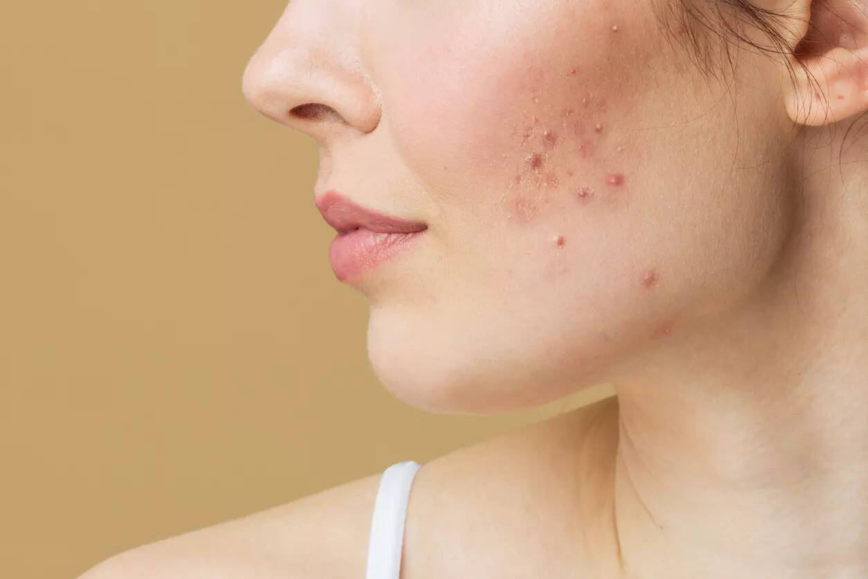 Adult acne Are you still having pimples in your 30s and 40s Heres how to get rid of them