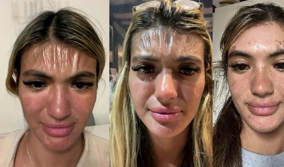 Woman who fell asleep in the sun for 30 minutes wakes up with plastic forehead