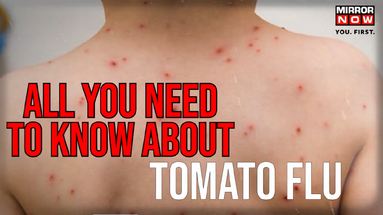 After Covid19 & Monkeypox, Tomato Flu grips India; What is this new