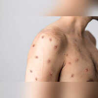 The recent global outbreak of monkeypox has led to more than 45500 cases as of August 22 2022 While symptoms usually resolve on their own in 2-4 weeks a recent study showed that 13 per cent of patients needed hospitalisation