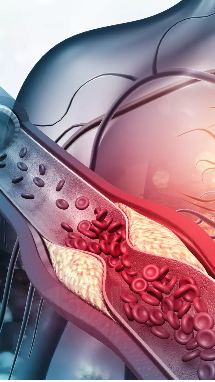 Is high cholesterol a crisis