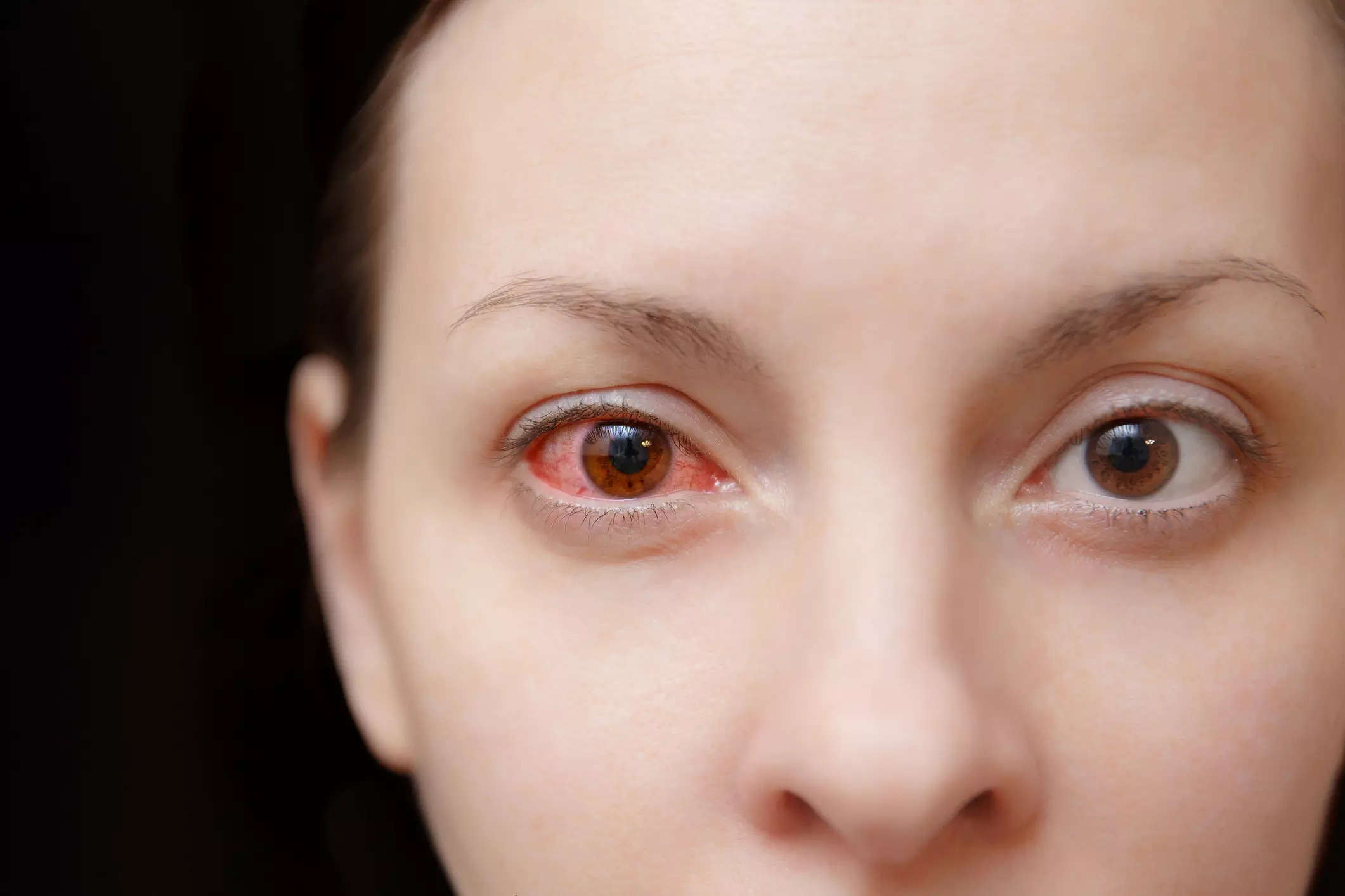 Red eyes 5 causes of eye pain that you should know
