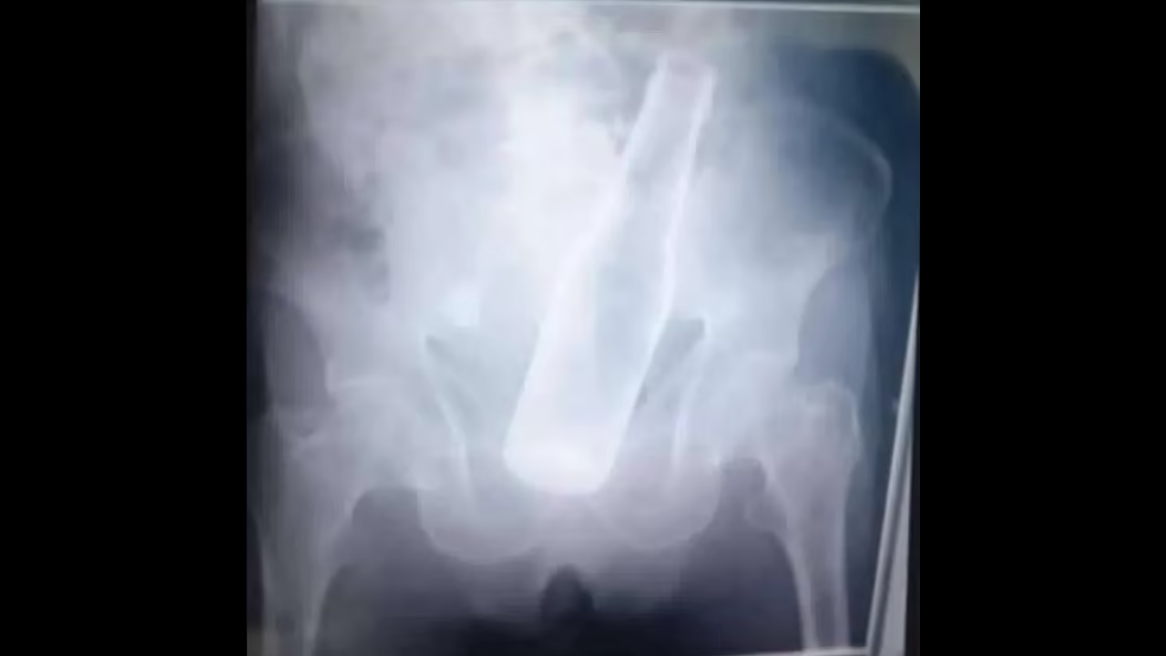 Man goes to hospital with beer bottle stuck in his rectum