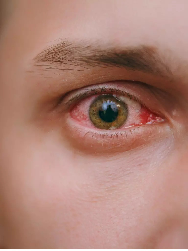 Conjunctivitis