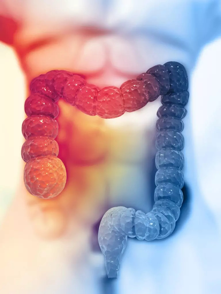 Colon cancer