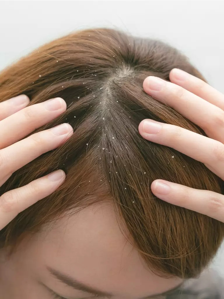 Food to eat to prevent dandruff