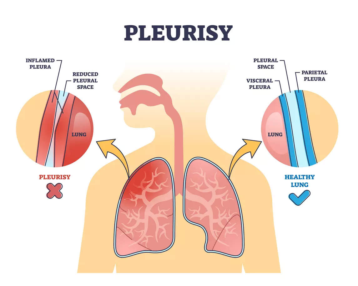 cautious-a-simple-cough-or-sneeze-could-be-a-sign-of-this-deadly