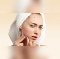 How to remove pimples 5 ways to get rid of pimples fast