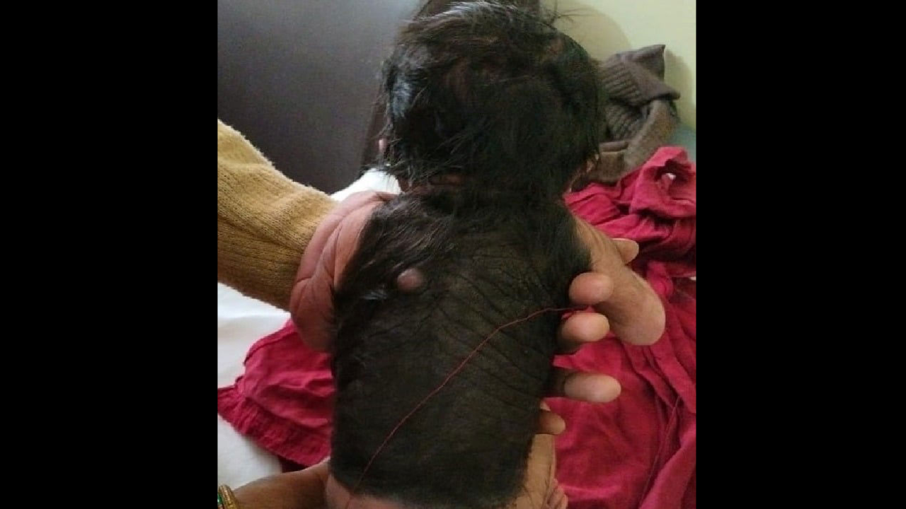 Baby born with 60 per cent body covered in hair in Uttar Pradesh's Hardoi