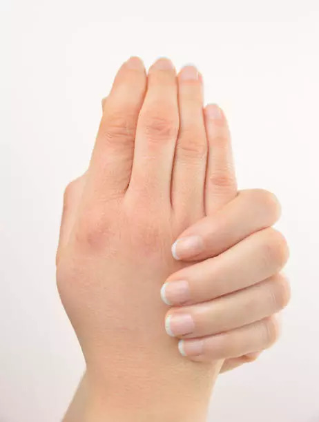 Cracking your knuckles causes arthritis