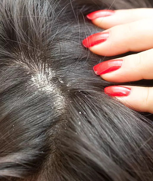 Dandruff flares up with increased stress