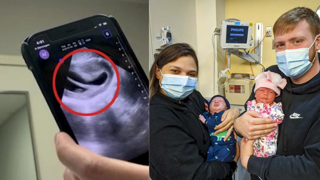 Woman with heart shaped uterus gives birth to one in 500 million twins