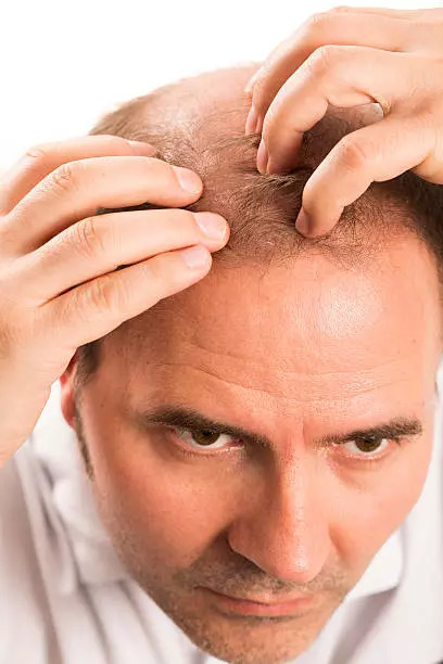 Bald hair patches