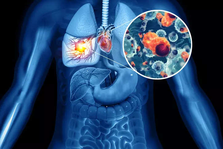 The team created Sybil, a deep-learning model that analyses scans and predicts lung cancer risk for the next one to six years, using data from the National Lung Screening Trial (NLST) in the US, the study said.