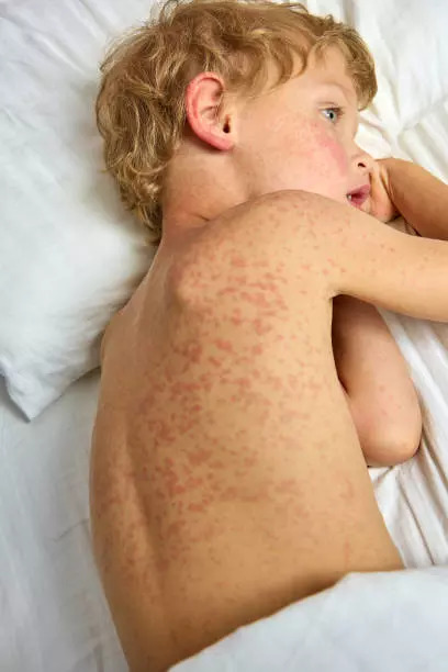 Skin rash