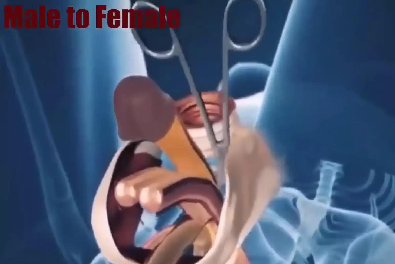 Animated video showing male to female Gender-affirming surgery goes viral,  fascinates viewers