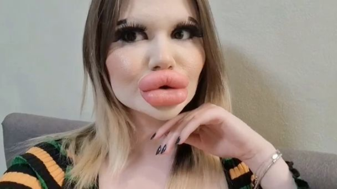 Woman With Worlds Biggest Lips Wants Huge Cheekbones Too 