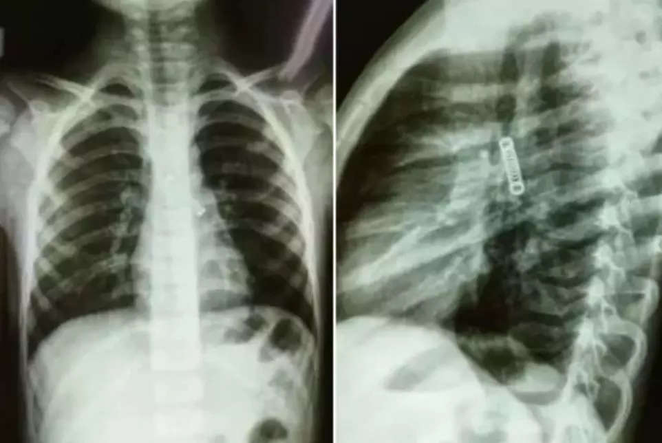 5yo-boy-can-t-stop-coughing-for-3-months-doctors-notice-something