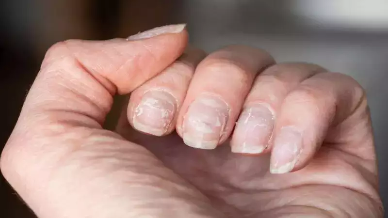 6 Reasons why you have brittle nails and how to take care of them