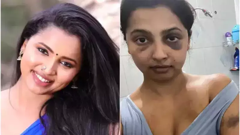 Malayalam actress Anicka Vikhraman shares shocking pictures of bruises after assault by boyfriend