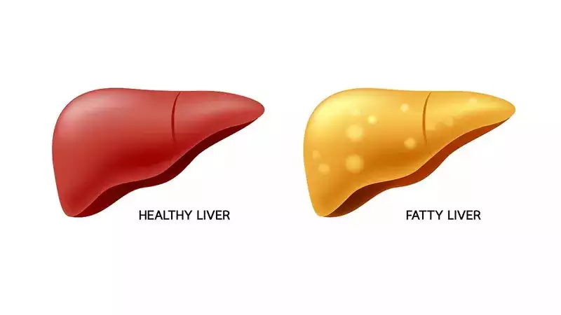 The ultimate guide to reversing fatty liver disease with simple lifestyle changes