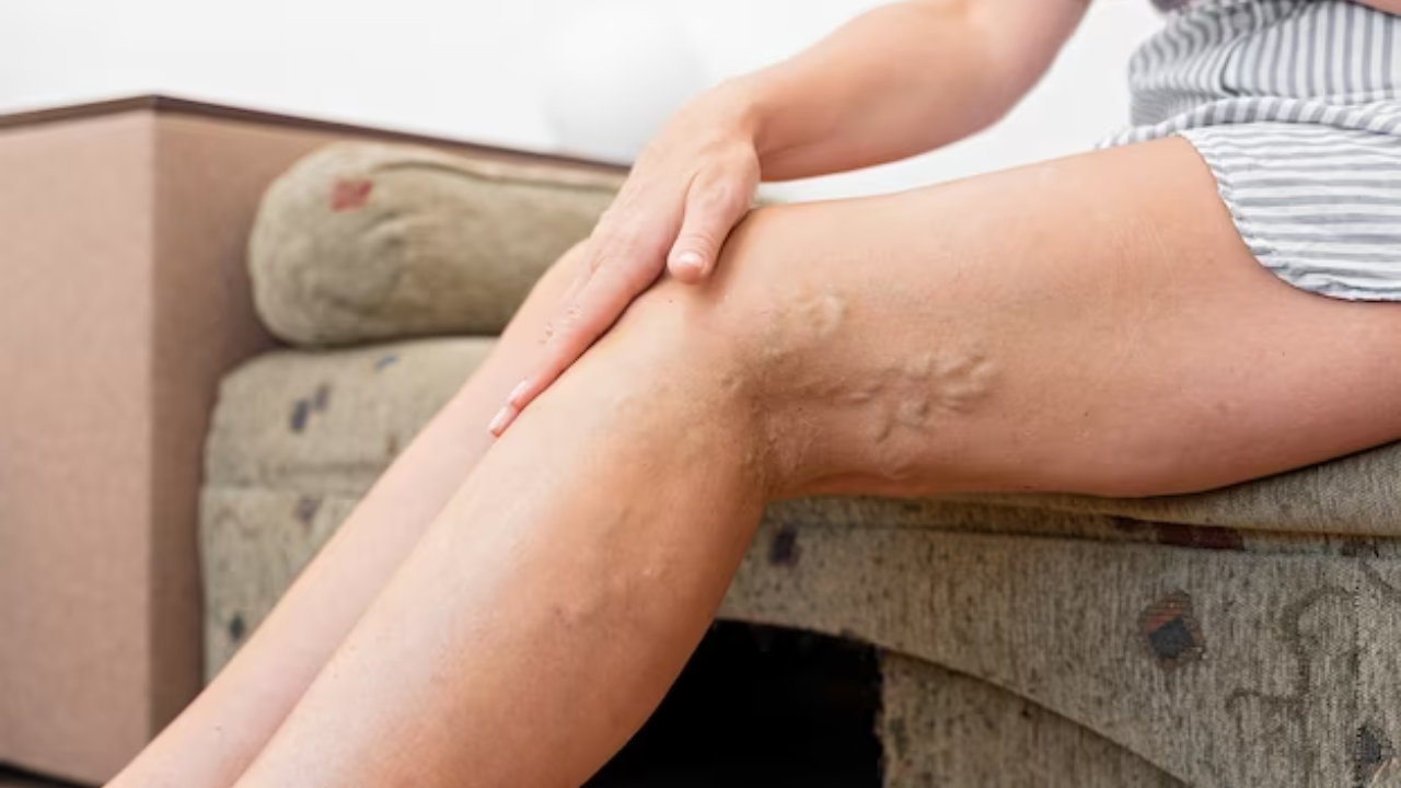 Ayurvedic Remedies For Spider Veins