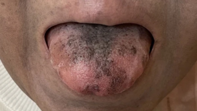 Tetracyclineinduced black hairy tongue  Sakaguchi  2020  Journal of  General and Family Medicine  Wiley Online Library