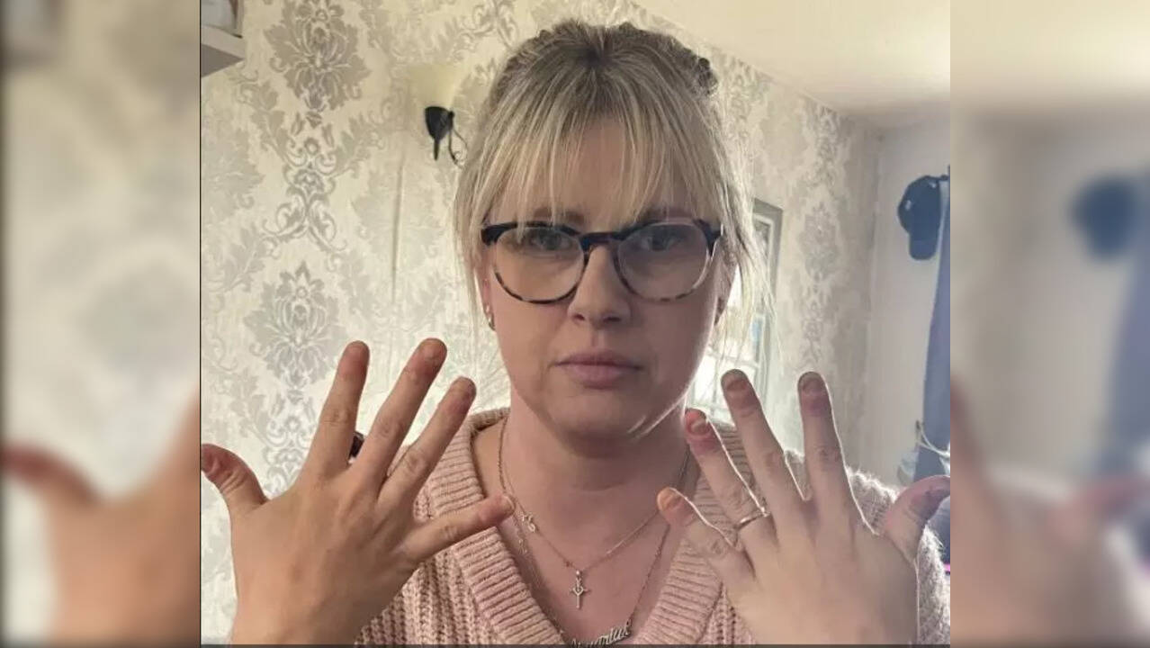A Deadly Allergy To Nail Polish Causes Woman To Lose Movement in