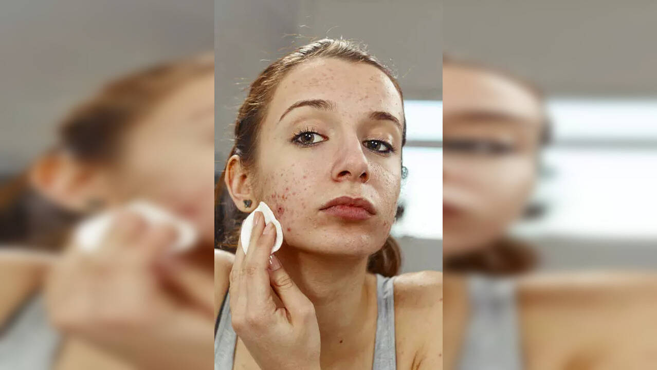 8 Effortless Home Remedies That Reduce Pimples Naturally 8 Effortless Home Remedies That Reduce Pimples Naturally