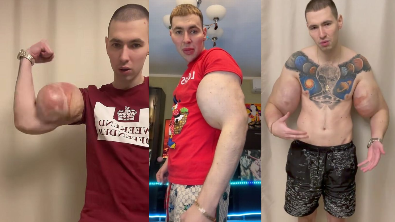 Man Dubbed 'Russian Popoye' For Injecting Oil In Arms, Netizens Ask How Does He Put His Shirt On