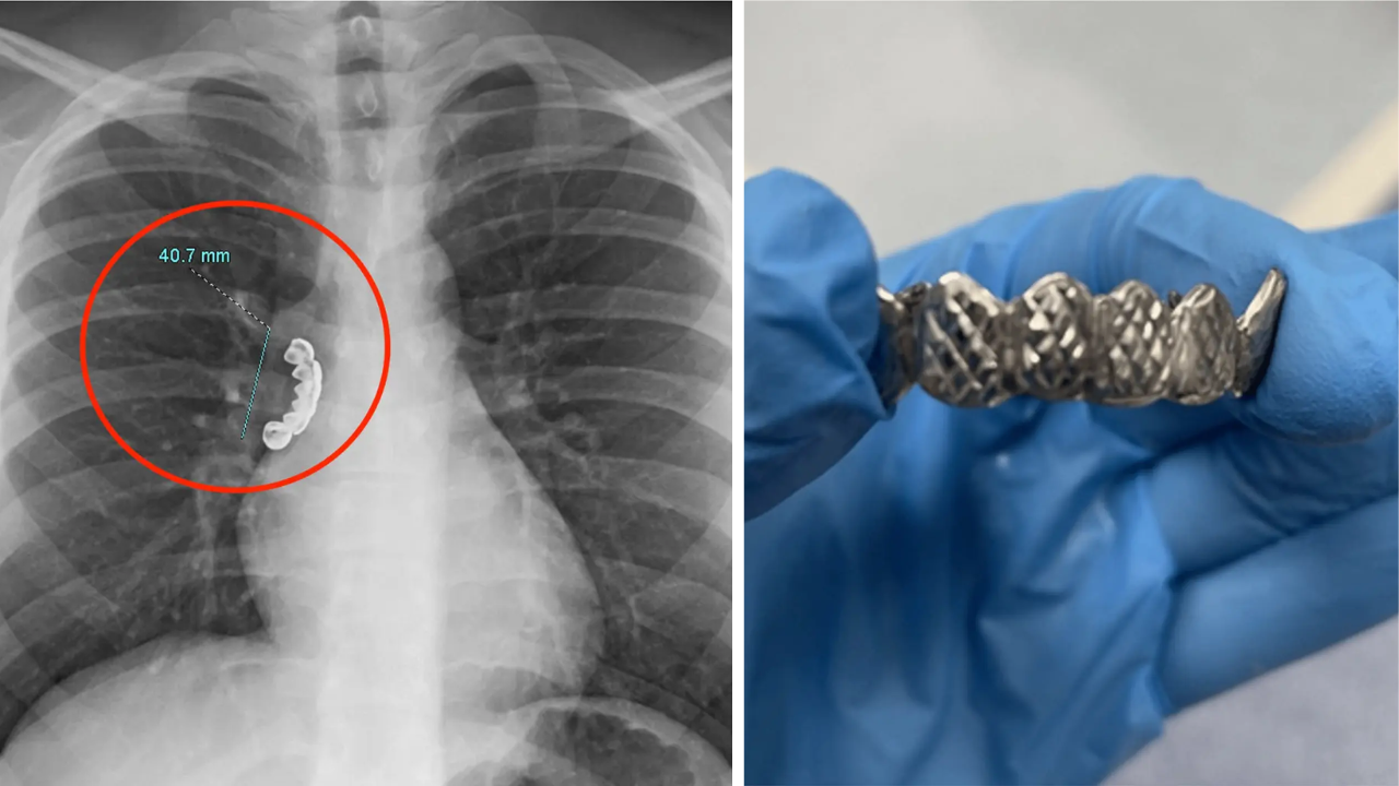 Man gets dentures stuck in his lungs.