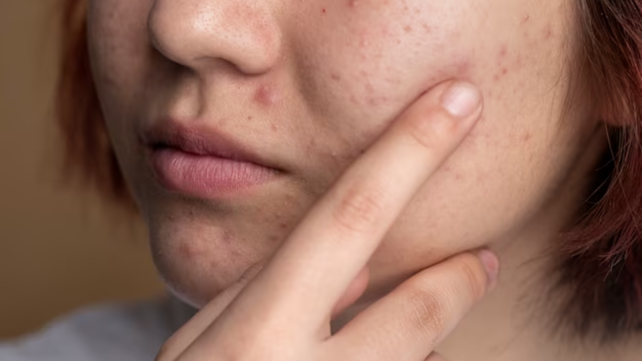 Acne On Face Indicates The Health Of Your Internal Organ