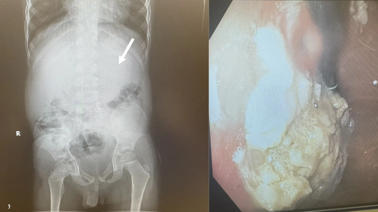 Gum in belly of 5 year old boy