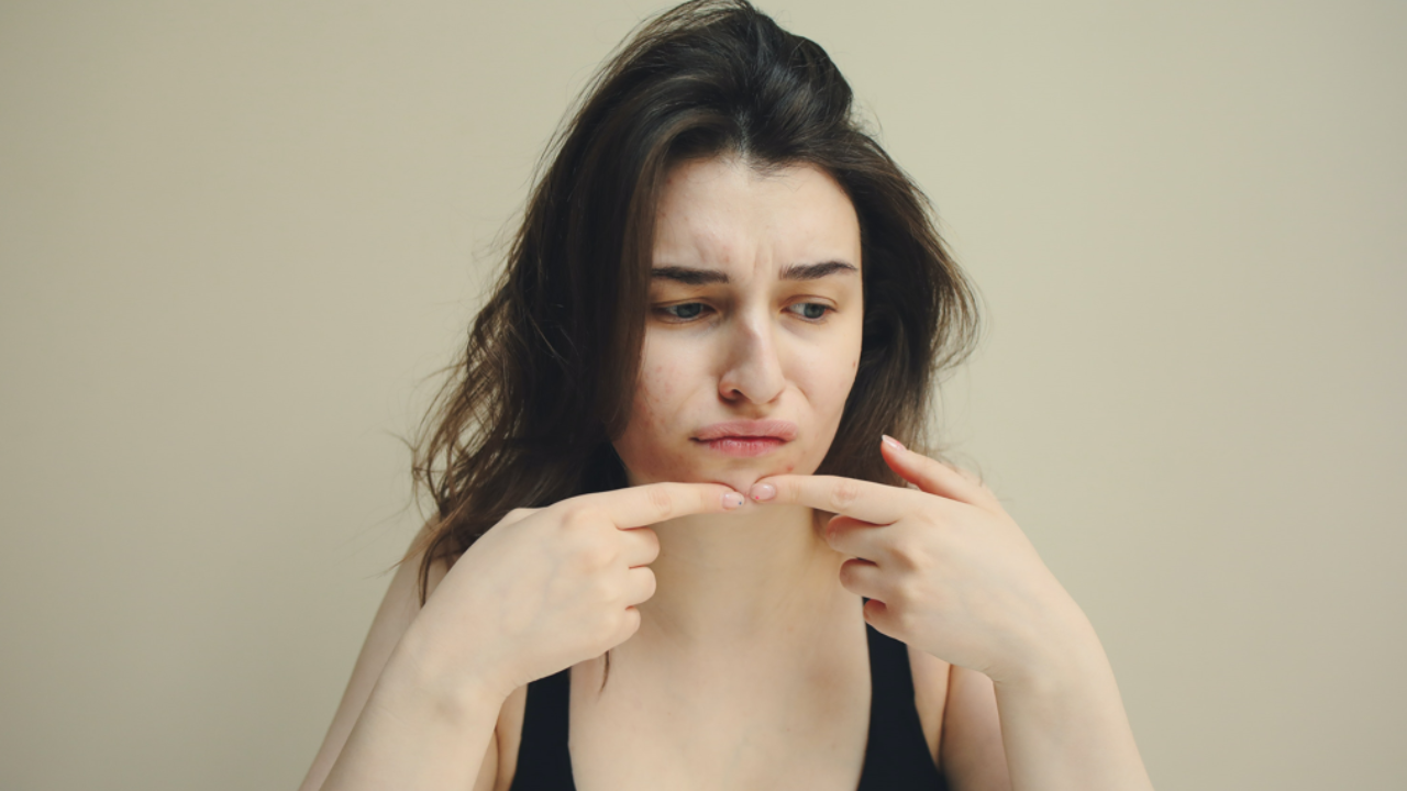 Should Birth Control Pills And Oral Contraceptives Be Taken For Acne? Pic Credit: Pexels