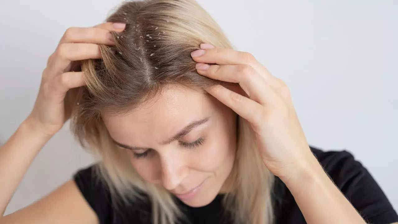 Dandruff treatment