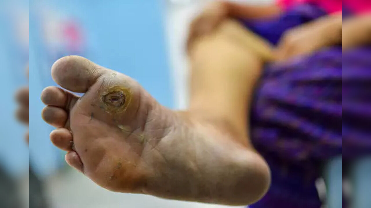 5 Warning Signs Of Diabetes On Your Skin That You Should Not Ignore - Vimarsana News