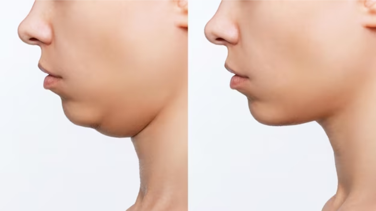 Ayurvedic Remedies To Reduce Double Chin