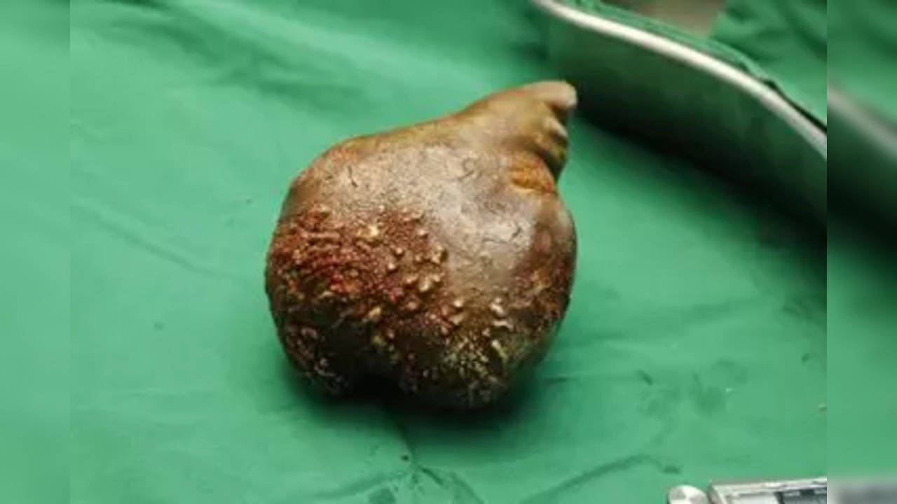 kidney stone