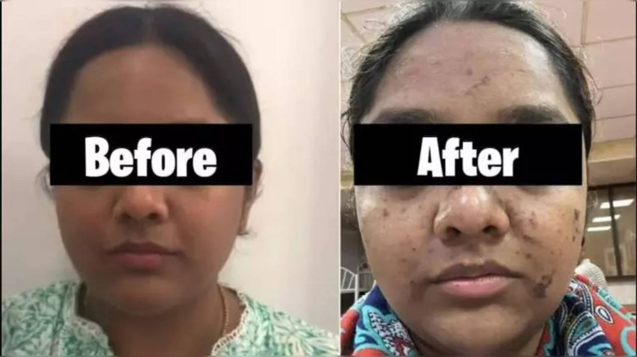 Woman Suffers Skin Burns After Rs.17,500 HydraFacial; Know The Risks