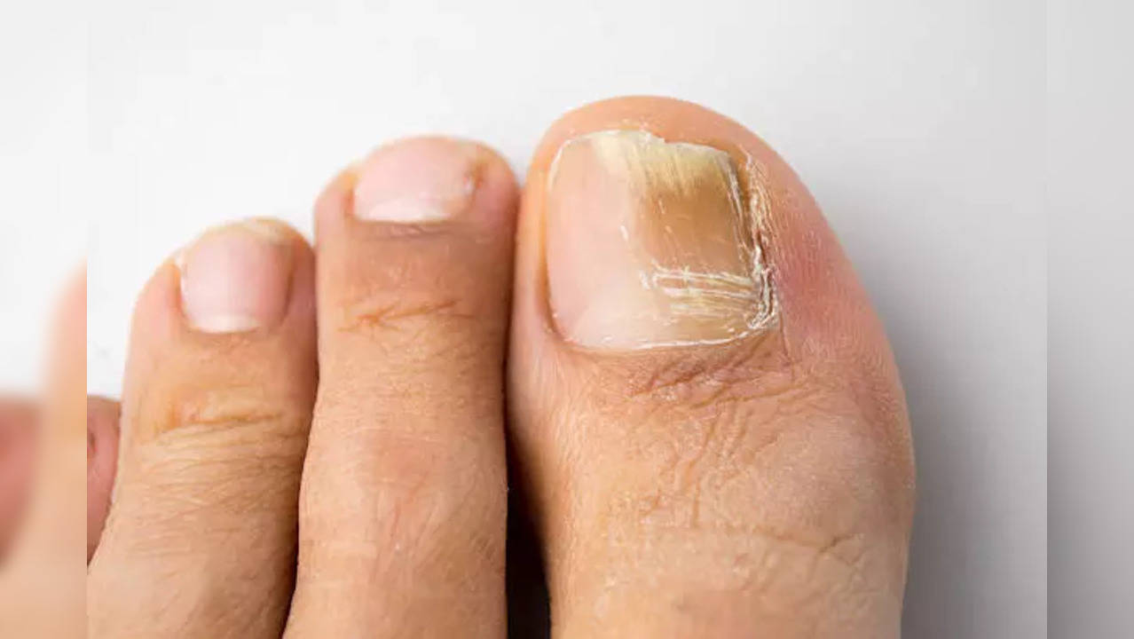 Fungal infections