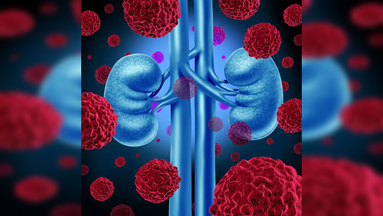 Kidney Cancer: Know All About The 4 Deadly Stages Of This Dangerous ...