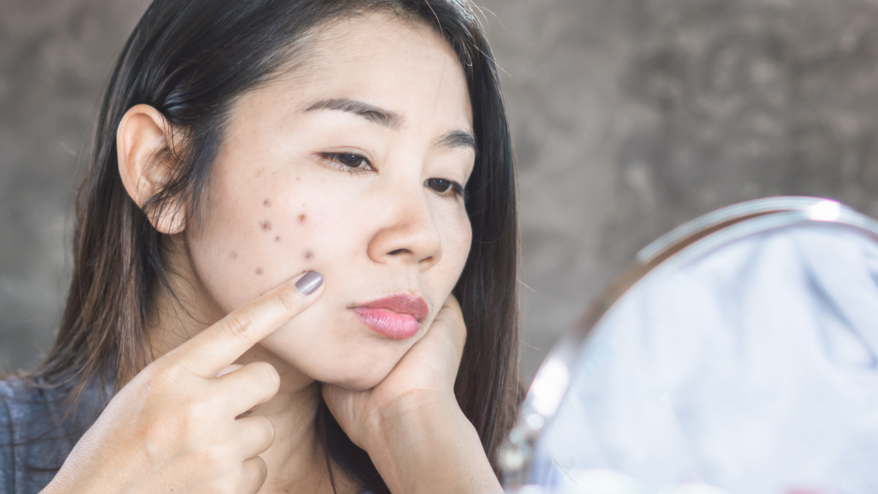 Hyperpigmentation on Skin