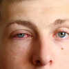 Suffering From Pink Eyes As cases Of Conjunctivitis Surge Across India Know How To Combat It