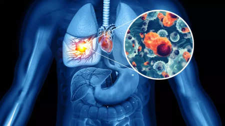 World Lung Cancer Day 2023: Check Here the Early Signs of the Deadly  Disease | HealthBeat | Health News, Times Now